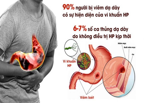 FTT_Vi khuẩn HP và dạ dày: Mối quan hệ nguy hiểm tiềm ẩn