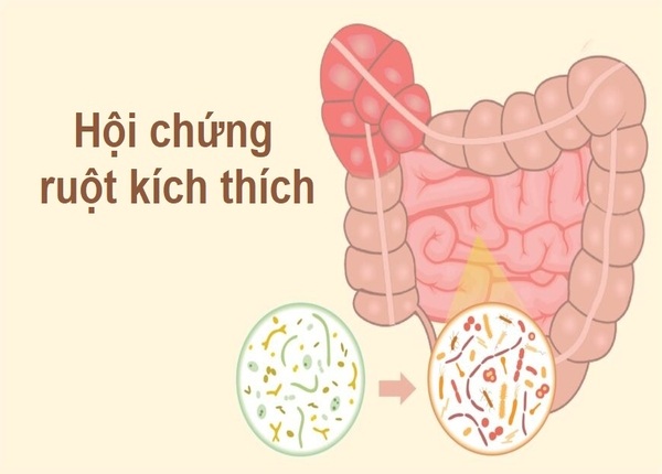 FTT_Men vi sinh có giúp cải thiện hội chứng ruột kích thích (IBS) không?